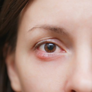 Abscesses Treatment Near Me in Houston, TX and Livingston, TX