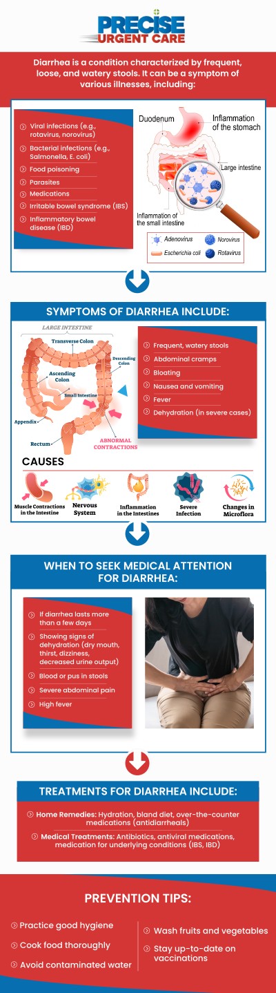 Common questions asked by patients: What causes diarrhea? When should I seek medical treatment for diarrhea? How long does diarrhea typically last? Can diarrhea be caused by food allergies or intolerances?
At Precise Urgent Care in Houston, TX, Board-Certified Dr. Rajan Popat, MD, and our team provide prompt diagnosis and relief for acute diarrhea and gastrointestinal distress. We focus on identifying the underlying cause while offering essential rehydration therapy to prevent complications and restore your digestive health. Visit our clinic for compassionate, professional care that helps you recover quickly and comfortably. For more information, contact us or online check-in. We are conveniently located at 22545 State Highway 249 Suite 130, Houston, TX 77070. We serve patients from Houston TX, Klein TX, Jersey Village TX, Willowbrook TX, Cypress TX, Tomball TX, and surrounding areas.