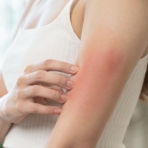 Rashes Treatment Near Me in Houston, TX and Livingston, TX