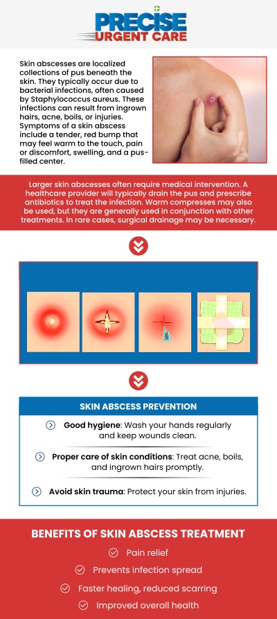 Common questions asked by patients: What is an abscess, and what causes it? How can I tell if I have an abscess? What are the common signs and symptoms of an abscess? Can an abscess heal on its own without treatment? How long does it take for an abscess to heal after drainage? At Precise Urgent Care, we skillfully diagnose and manage painful skin infections to prevent complications and restore your comfort. Board-Certified Dr. Rajan Popat, MD, and our team provide effective Abscess treatment, including safe incision and drainage, to ensure proper healing. We prioritize your relief and safety, delivering compassionate care for these sensitive conditions in a sterile, professional environment. For more information, contact us or online check-in. We are conveniently located at 22545 State Highway 249 Suite 130, Houston, TX 77070. We serve patients from Houston TX, Klein TX, Jersey Village TX, Willowbrook TX, Cypress TX, Tomball TX, and surrounding areas. Common questions asked by patients: What is an abscess, and what causes it? How can I tell if I have an abscess? What are the common signs and symptoms of an abscess? Can an abscess heal on its own without treatment? How long does it take for an abscess to heal after drainage?
At Precise Urgent Care, we skillfully diagnose and manage painful skin infections to prevent complications and restore your comfort. Board-Certified Dr. Rajan Popat, MD, and our team provide effective Abscess treatment, including safe incision and drainage, to ensure proper healing. We prioritize your relief and safety, delivering compassionate care for these sensitive conditions in a sterile, professional environment. For more information, contact us or online check-in. We are conveniently located at 22545 State Highway 249 Suite 130, Houston, TX 77070. We serve patients from Houston TX, Klein TX, Jersey Village TX, Willowbrook TX, Cypress TX, Tomball TX, and surrounding areas.