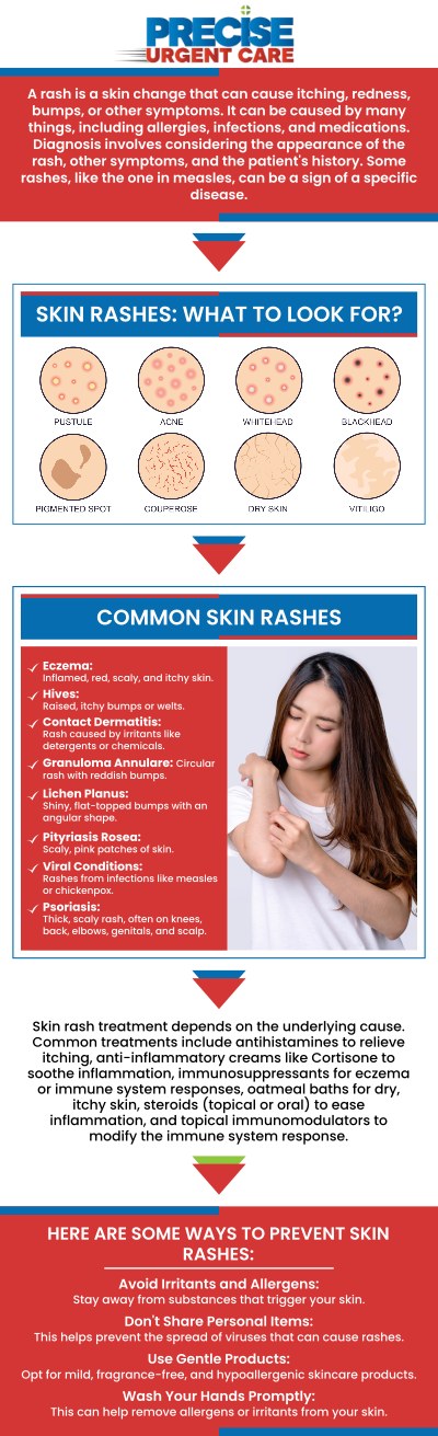Common questions asked by patients: What causes rashes on the skin? What are the common symptoms associated with a rash? Can rashes be contagious? How long does it take for a rash to heal? How do doctors treat rashes caused by infections? Should I visit urgent care for a rash? At Precise Urgent Care, Board-Certified Dr. Rajan Popat, MD, provides diagnosis and treatment for a wide variety of skin rashes and allergic reactions. Our medical team identifies the underlying cause of your skin irritation—whether from environmental triggers, infections, or heat—to provide fast and effective relief. For more information, contact us or online check-in. We are conveniently located at 22545 State Highway 249 Suite 130, Houston, TX 77070. We serve patients from Houston TX, Klein TX, Jersey Village TX, Willowbrook TX, Cypress TX, Tomball TX, and surrounding areas. Common questions asked by patients: What causes rashes on the skin? What are the common symptoms associated with a rash? Can rashes be contagious? How long does it take for a rash to heal? How do doctors treat rashes caused by infections? Should I visit urgent care for a rash?
At Precise Urgent Care, Board-Certified Dr. Rajan Popat, MD, provides diagnosis and treatment for a wide variety of skin rashes and allergic reactions. Our medical team identifies the underlying cause of your skin irritation—whether from environmental triggers, infections, or heat—to provide fast and effective relief. For more information, contact us or online check-in. We are conveniently located at 22545 State Highway 249 Suite 130, Houston, TX 77070. We serve patients from Houston TX, Klein TX, Jersey Village TX, Willowbrook TX, Cypress TX, Tomball TX, and surrounding areas.