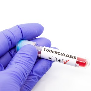Tuberculosis Testing (PPD) Near Me in Houston, TX and Livingston, TX